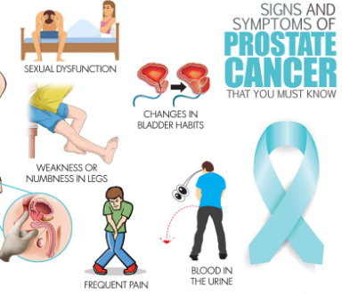 Prostate Cancer Overview -Causes ,Early Symptoms & Treatment