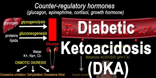 Diabetic Ketoacidosis definition explained